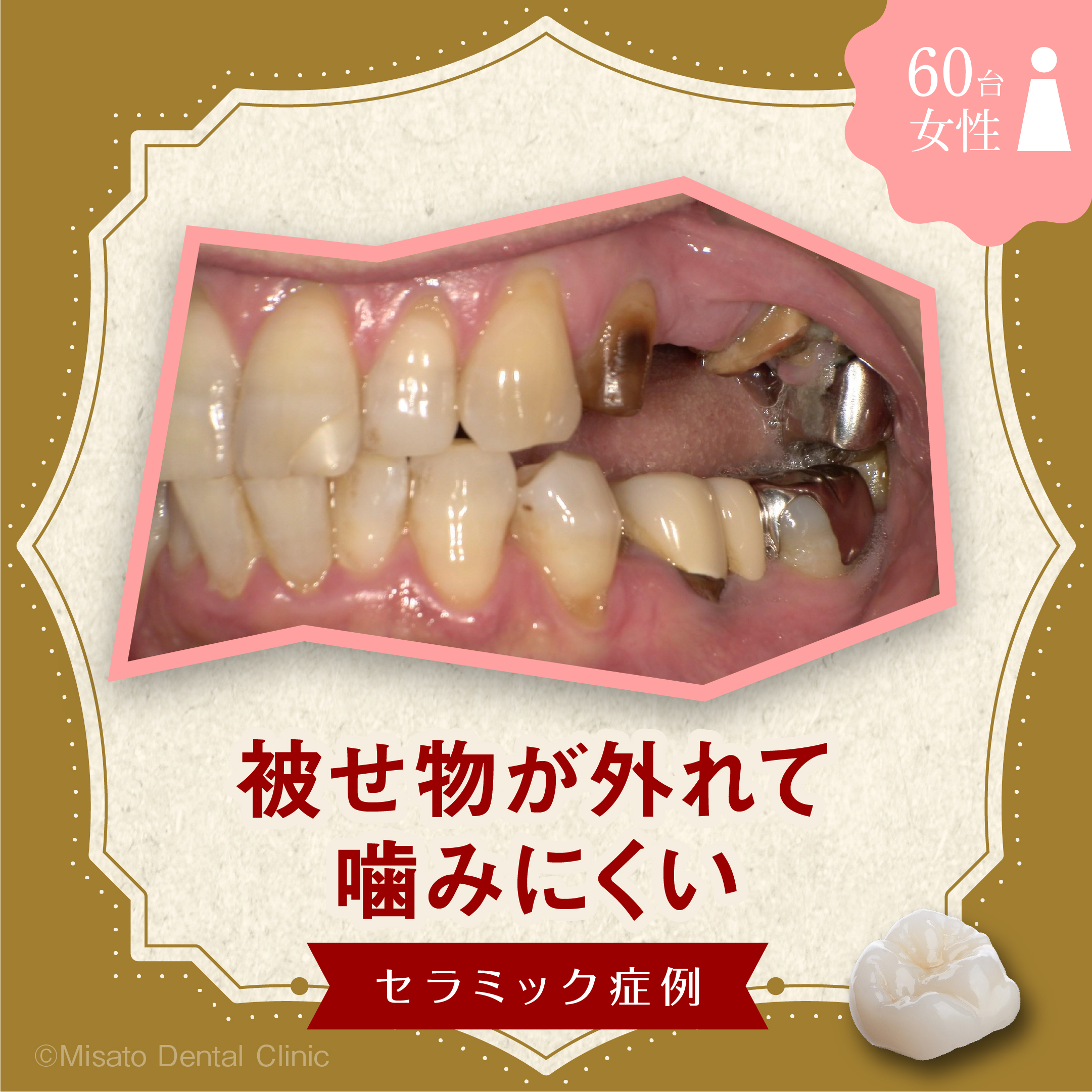 被せ物が外れて噛みにくい