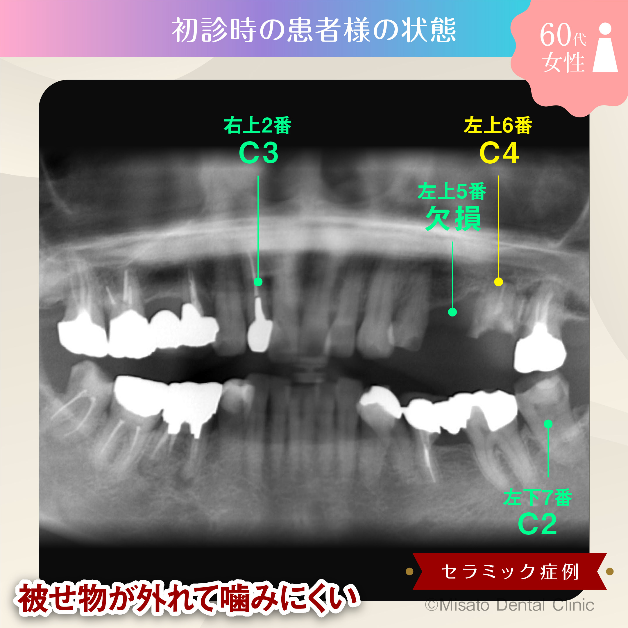 初診時の状態(レントゲン)