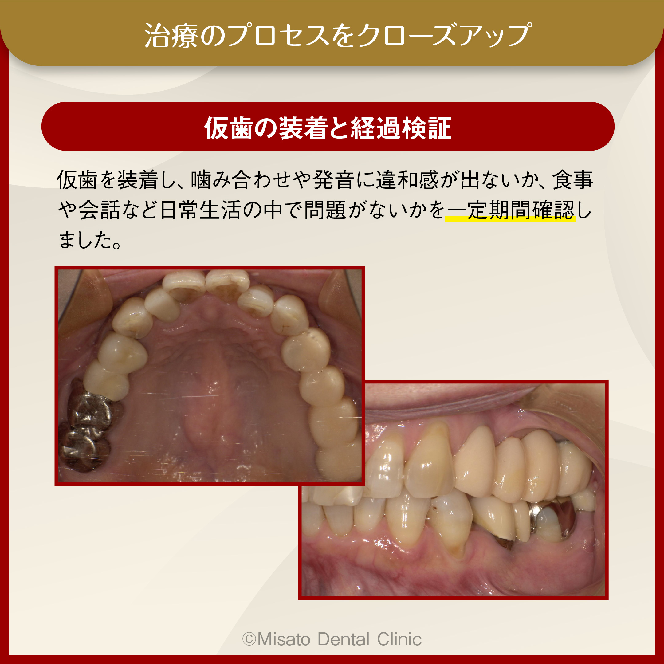 仮歯の装着と経過検証