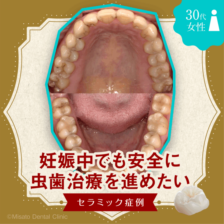 「妊娠中でも安全に虫歯治療を進めたい」セラミック症例