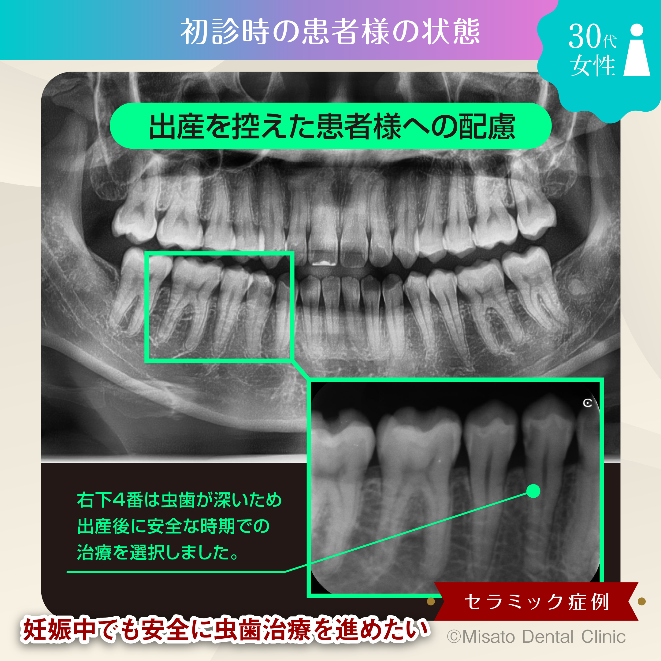 初診時の状態(レントゲン)
