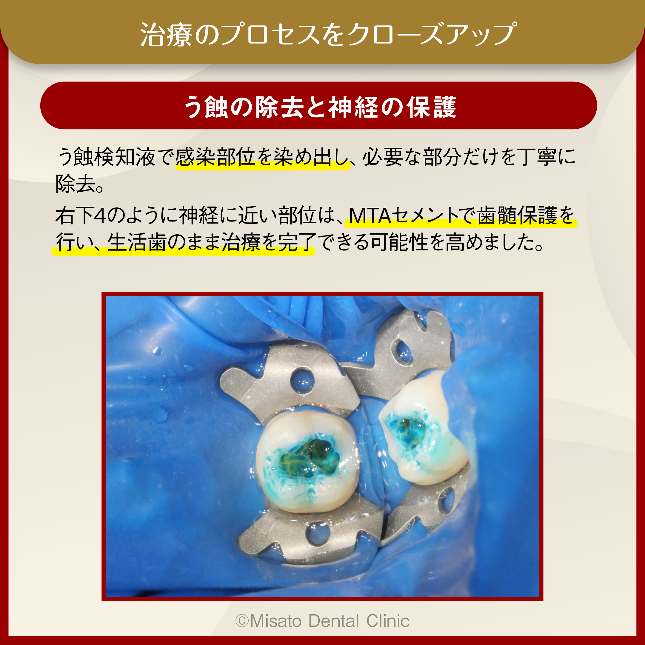 う蝕の除去と神経の保護