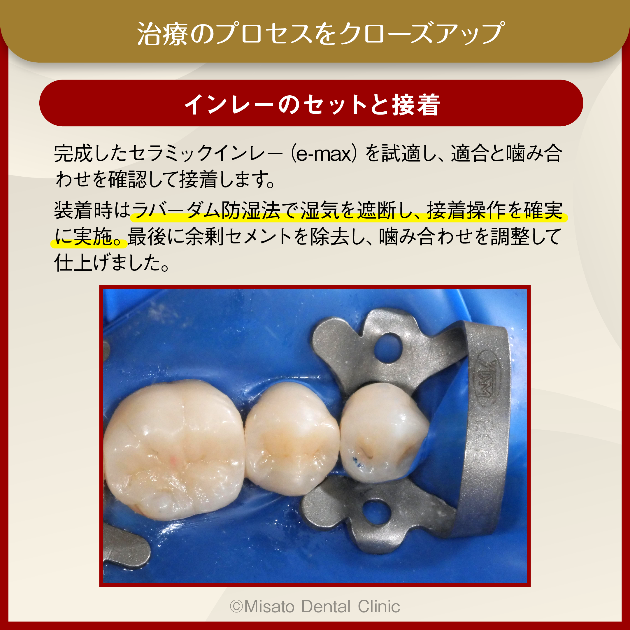 インレーのセットと接着