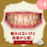 痛みはないけど、虫歯が心配...