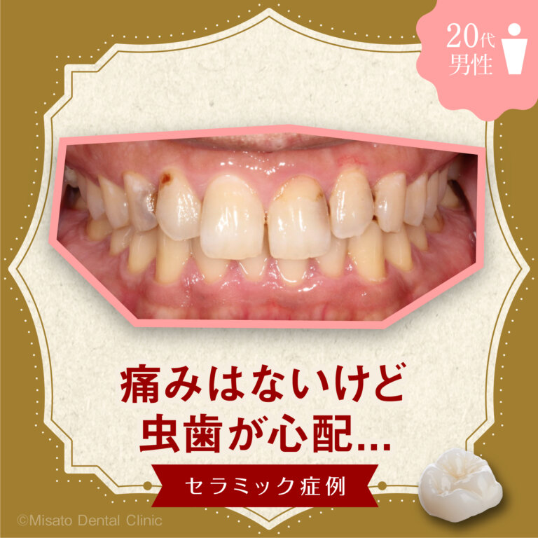 「痛みはないけど、虫歯が心配…」セラミック症例
