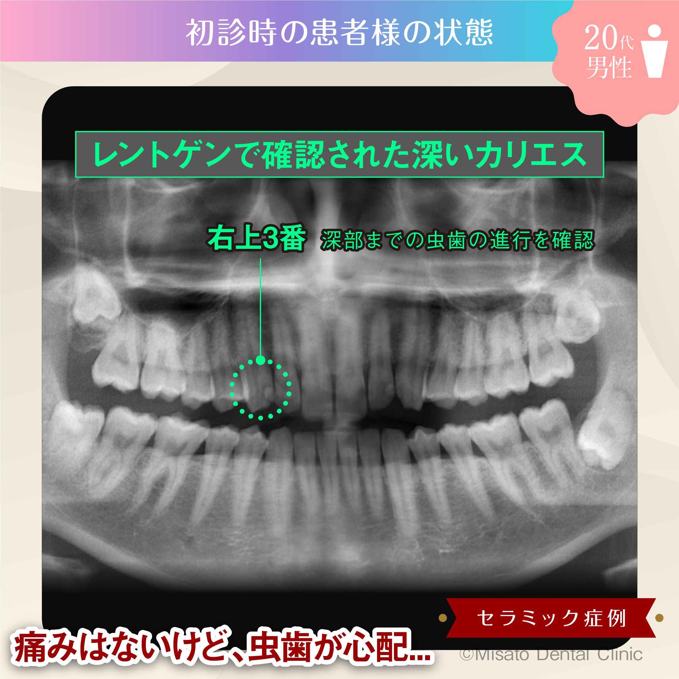 初診時の状態（レントゲン）