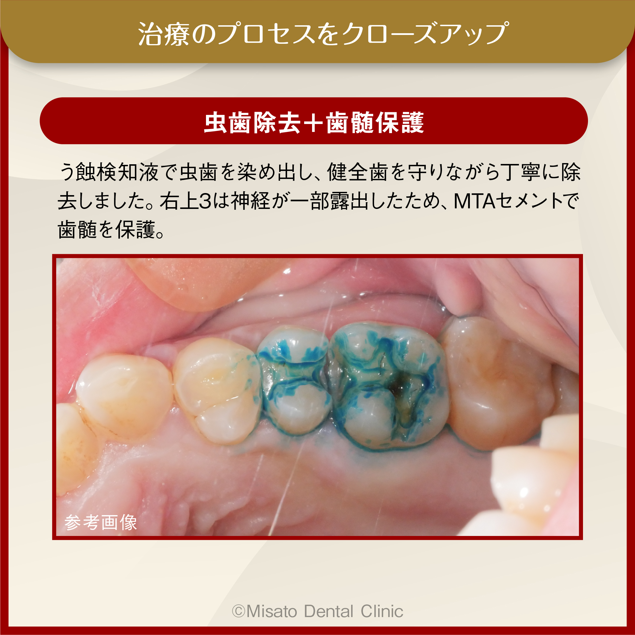 虫歯除去＋歯髄保護
