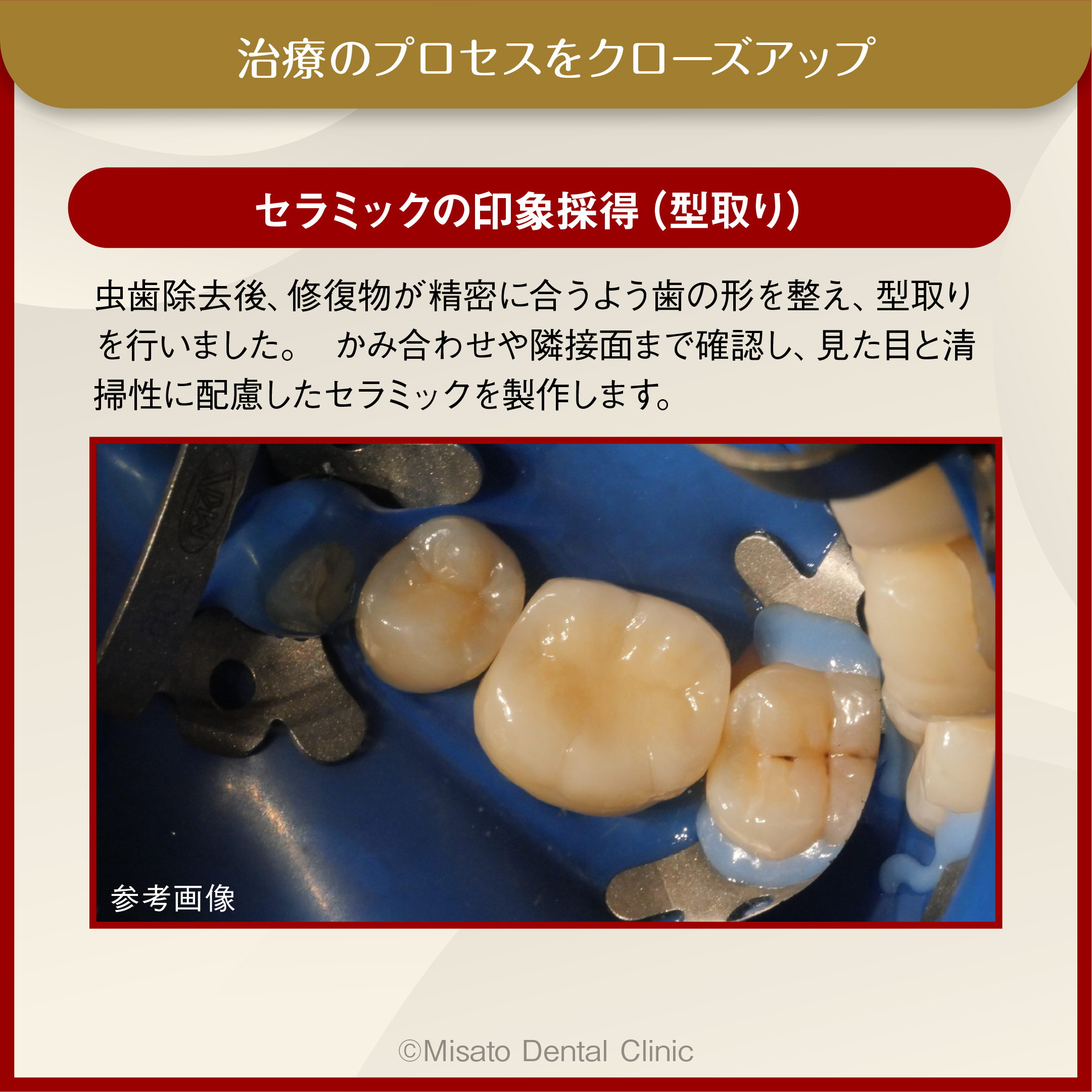 セラミックの印象採得（型取り）