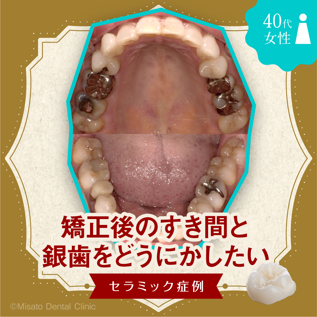 「矯正後のすき間と銀歯をどうにかしたい」セラミック症例