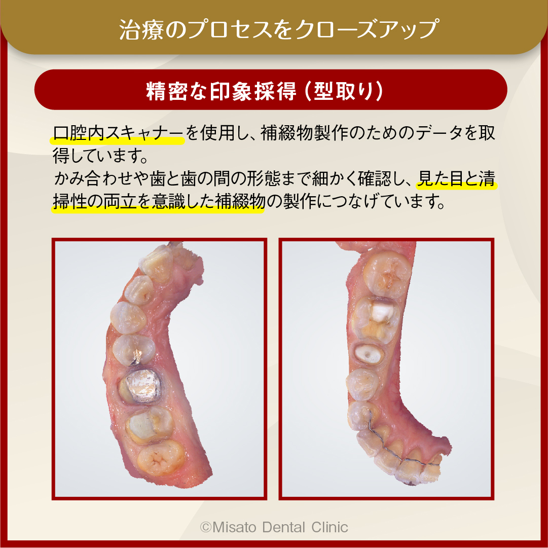 精密な印象採得（型取り）