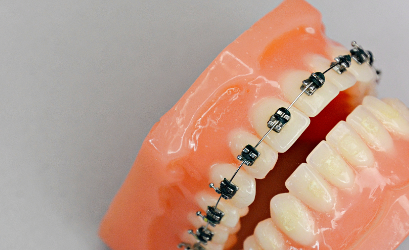 ワイヤー矯正の模型