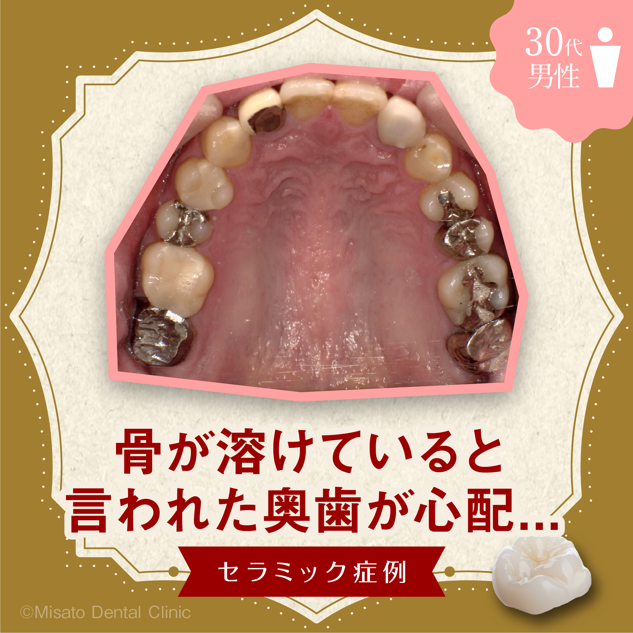 「骨が溶けていると言われた奥歯が心配」セラミック症例