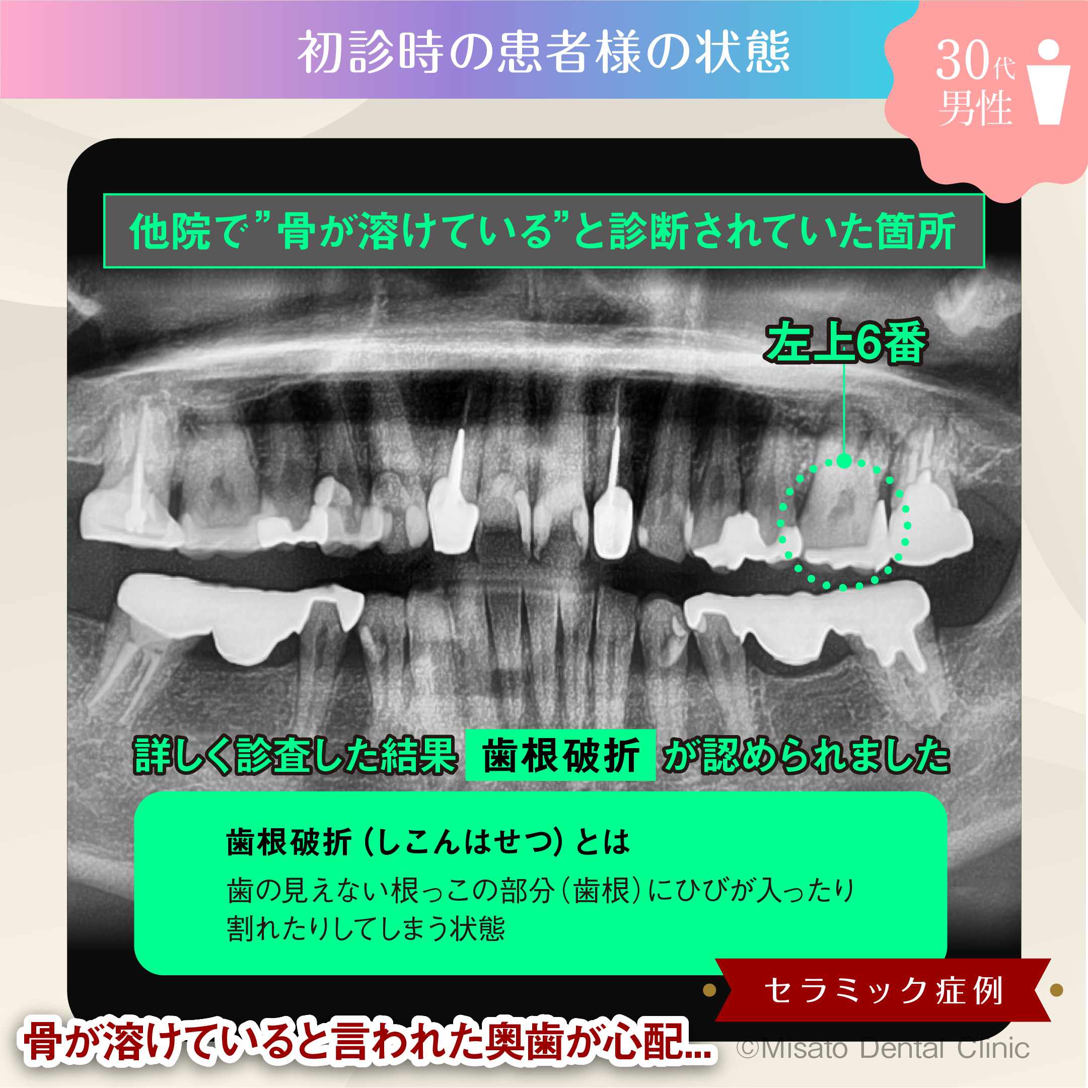 初診時の状態(レントゲン)