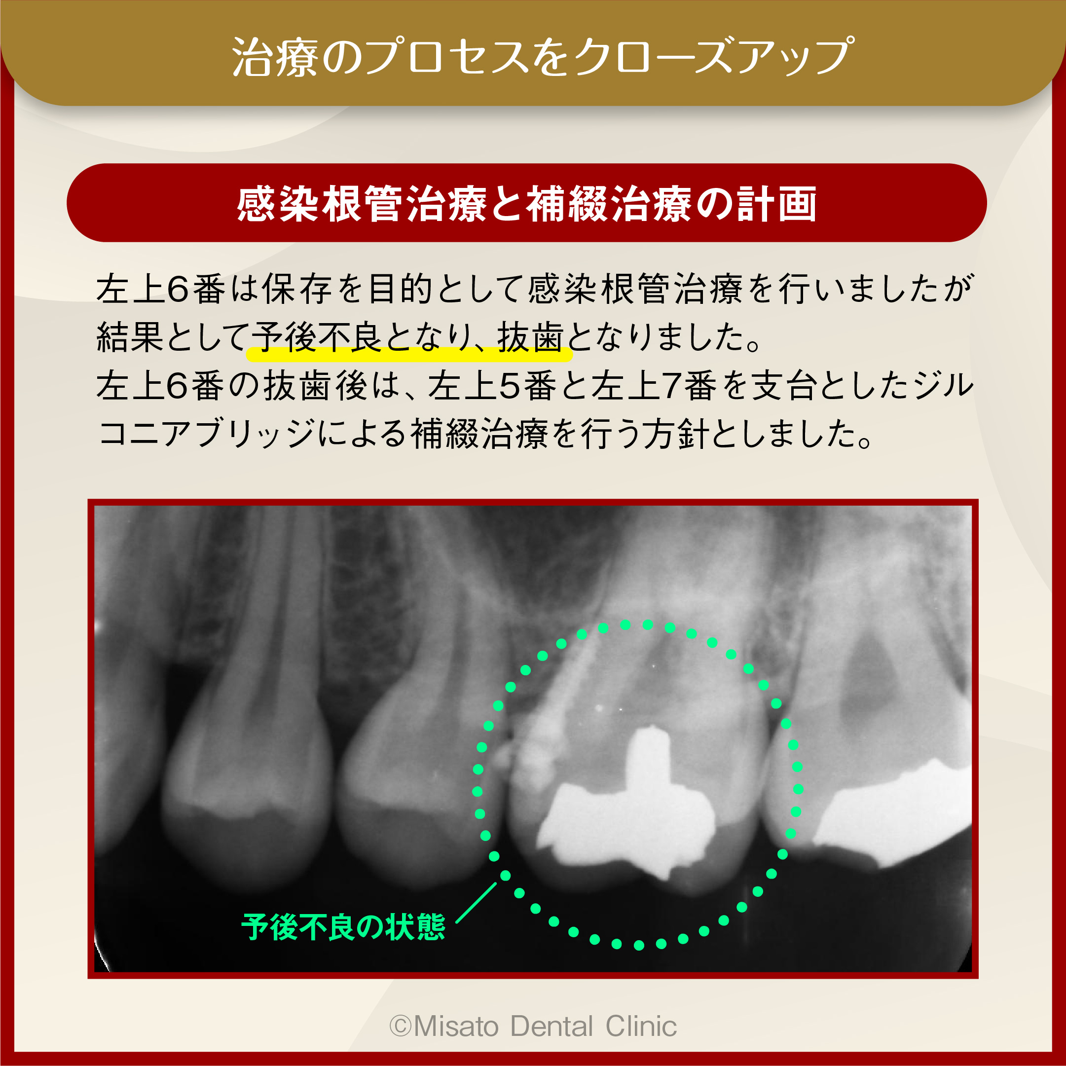 感染根管治療と補綴治療の計画