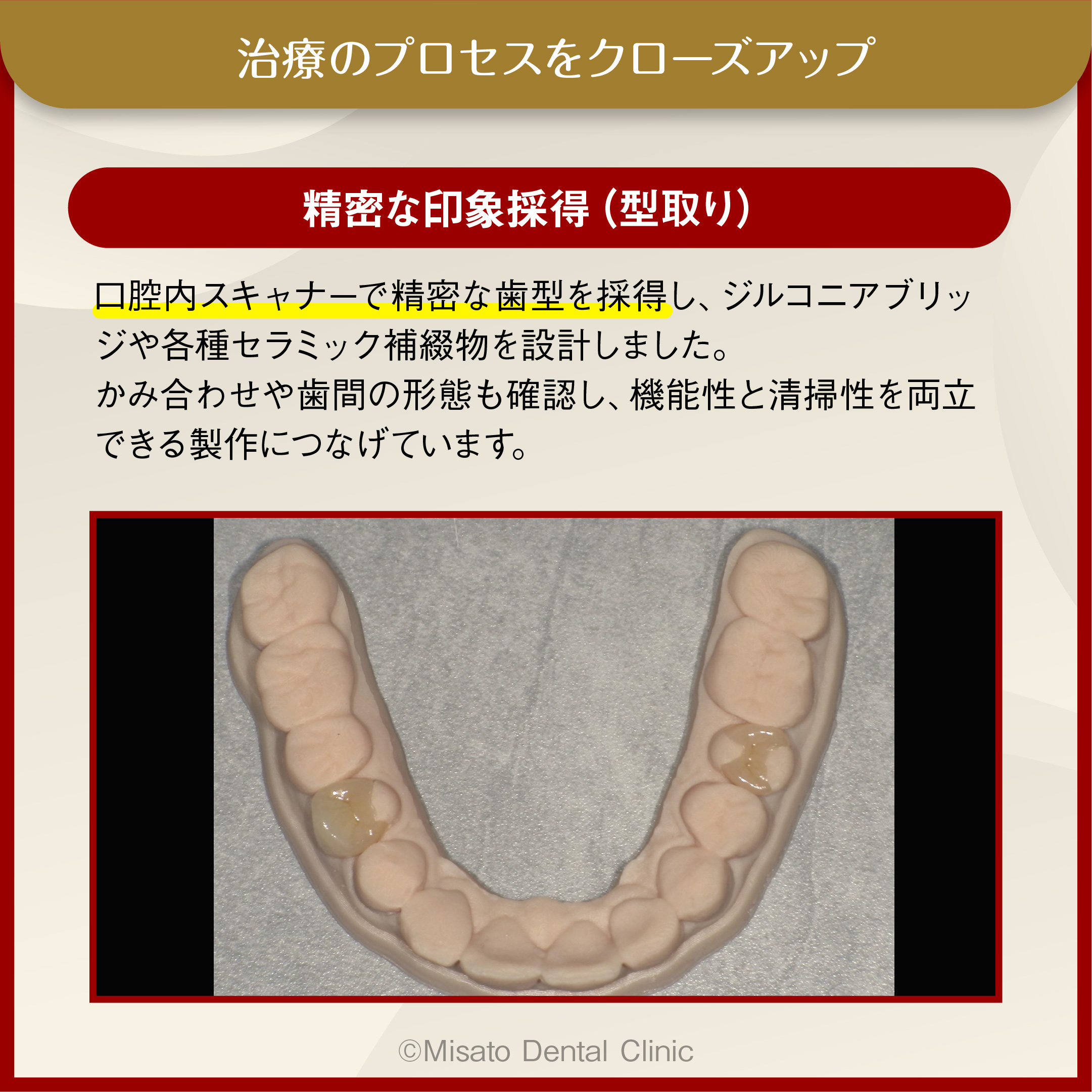 精密な印象採得(型取り)