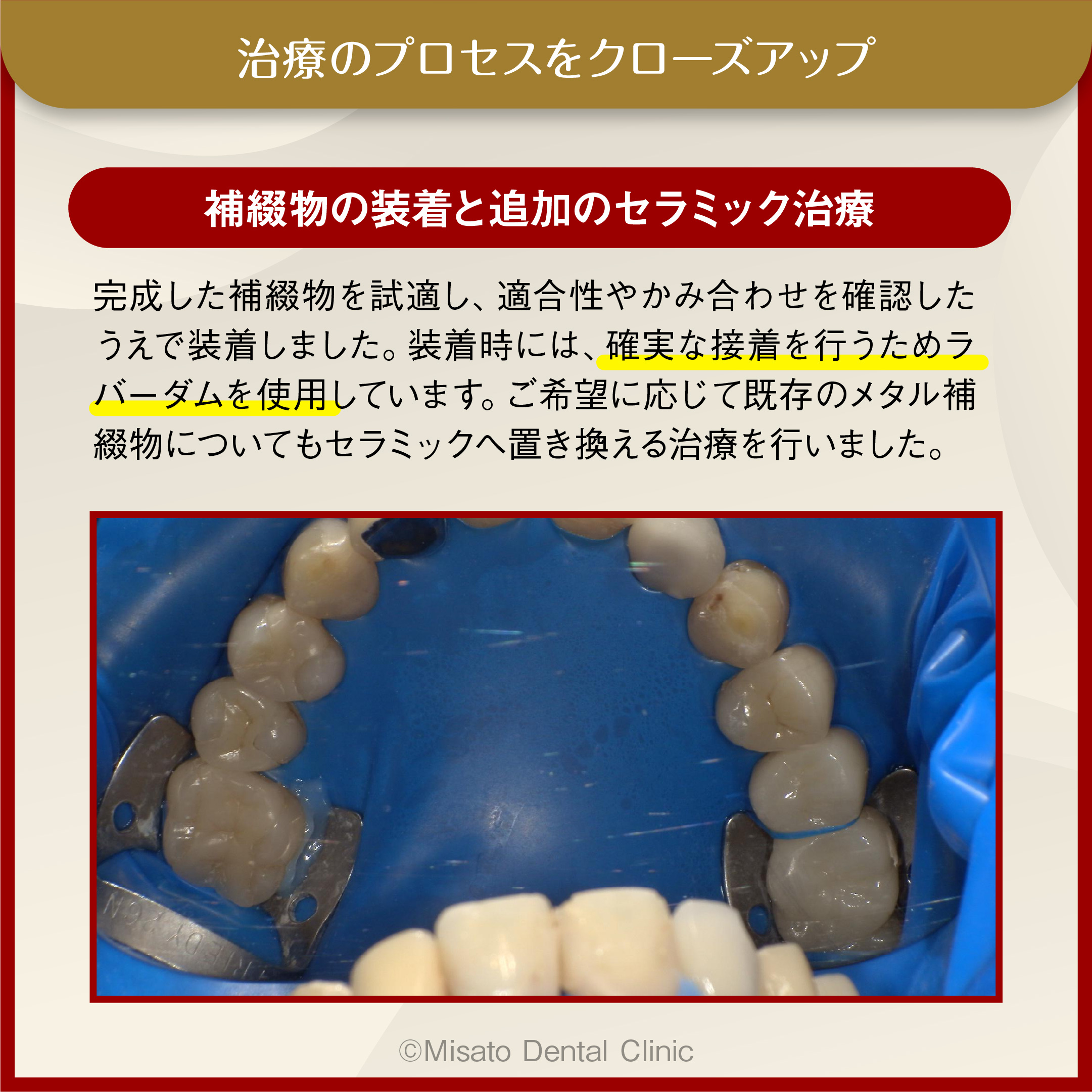 補綴物の装着と追加のセラミック治療
