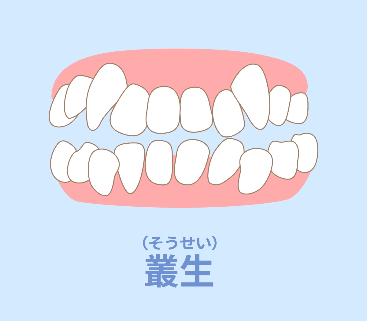 八重歯の構造