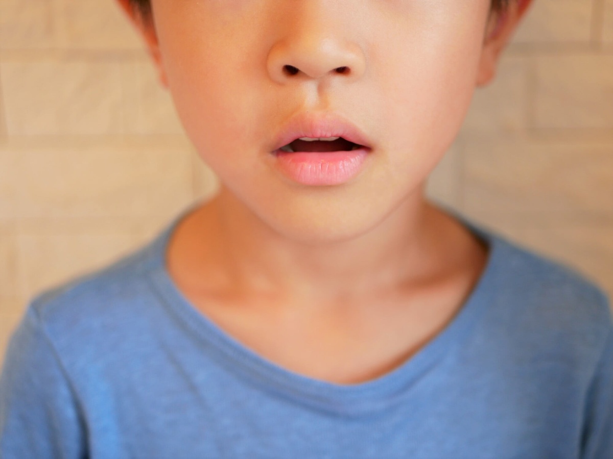 口呼吸している子どもの口